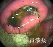 胃潰瘍會給人帶來什么危害