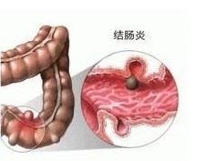 什么是結腸炎？結腸炎的癥狀有哪些？